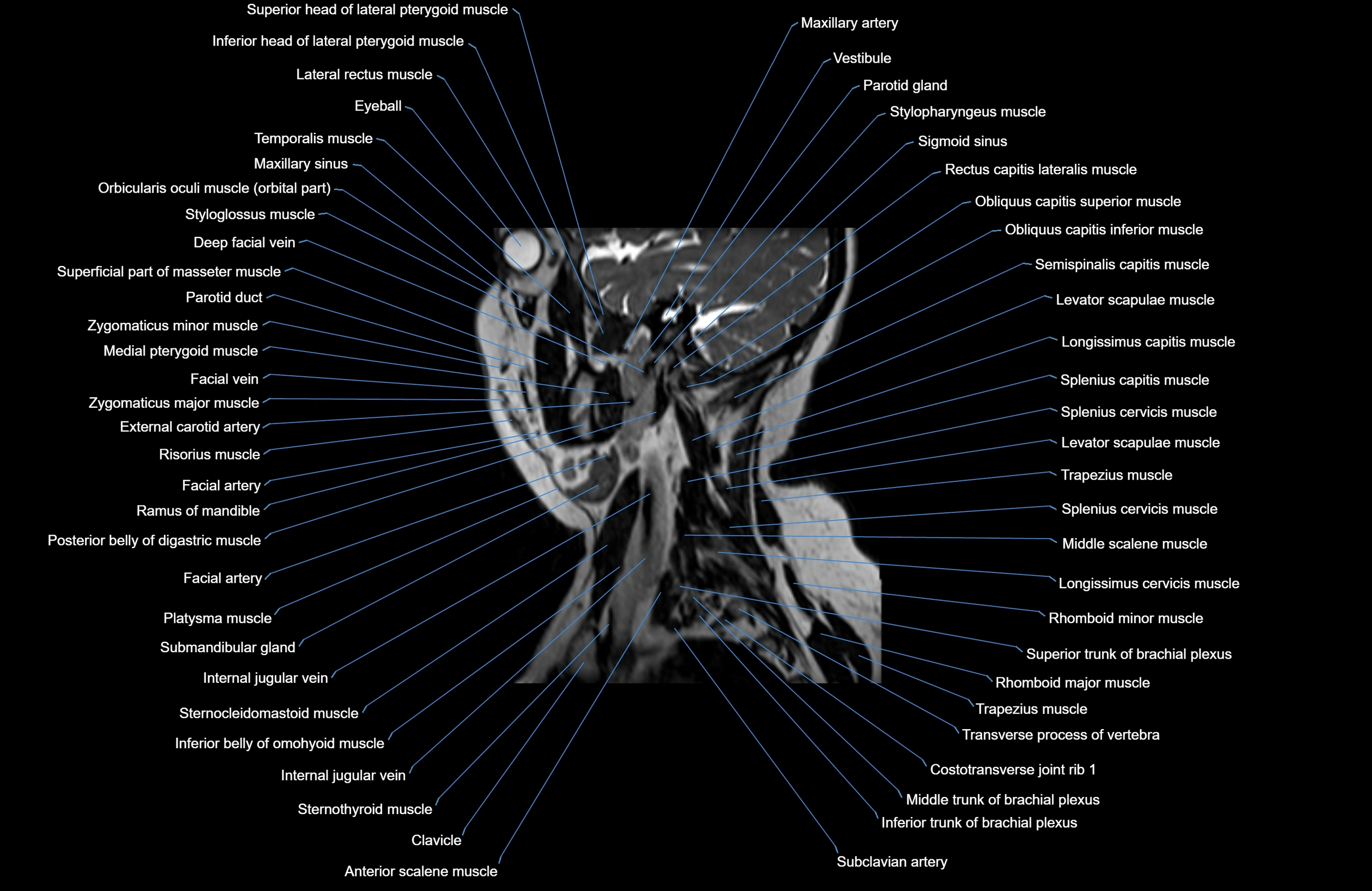 Neck MRI sagittal cross sectional anatomy 3D 1mm 3T radiology  image-img-00001-00024.webp